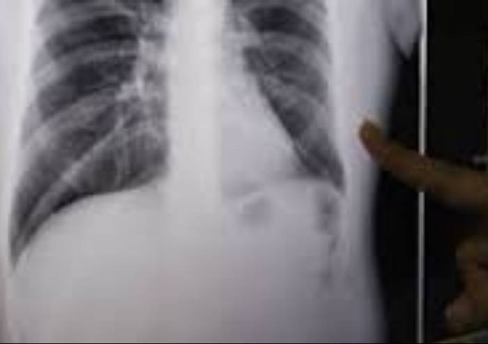 Modena, un caso di tubercolosi