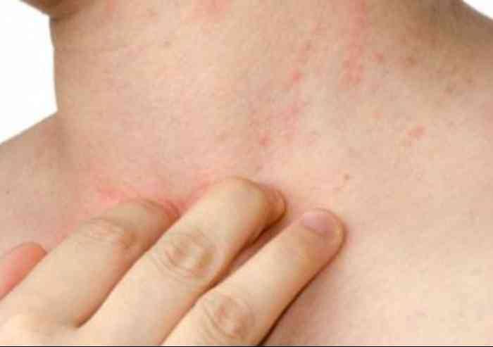 Scabbia, ancora tre casi a Carpi: colpiti i bambini