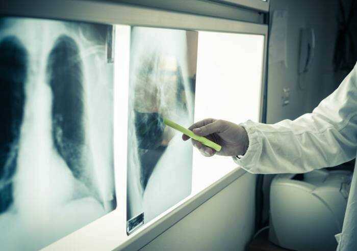 Covid, cresce il focolaio variante Omicron in Campania