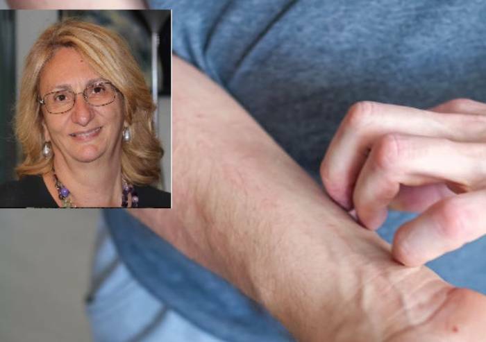 'Vaiolo scimmie, studio in 13 paesi con firma Unimore: il 98% degli infetti è omosessuale o bisessuale'