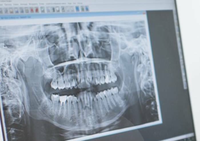 Impiantologia computer guidata: la tecnologia a servizio del benessere
