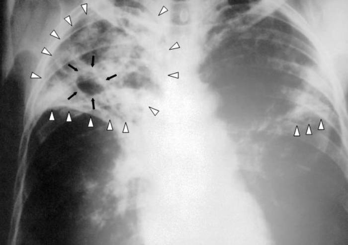 Carpi, segnalato un caso di tubercolosi polmonare