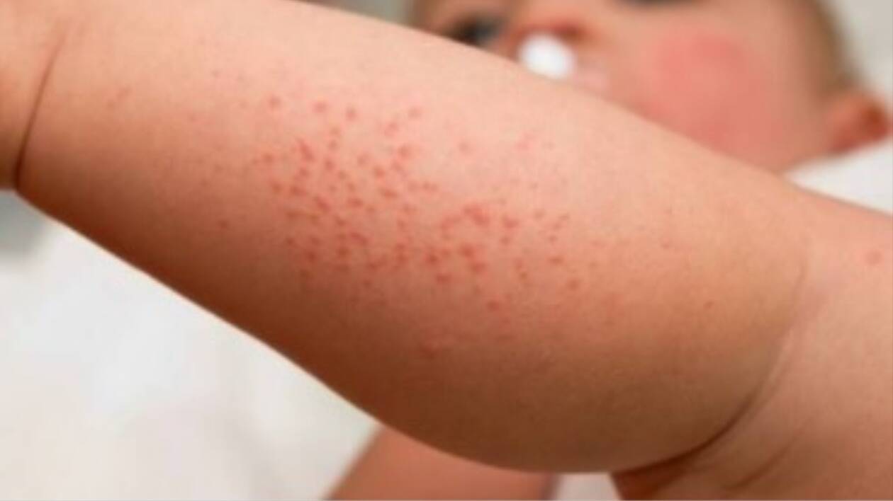 Scabbia, a Modena boom di casi: 1.170 in un anno
